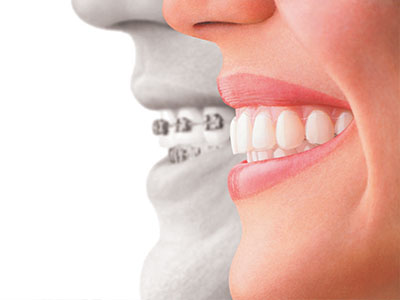Dr. Anthony Iuvone, DMD | Invisalign reg , Inlays  amp  Onlays and Extractions