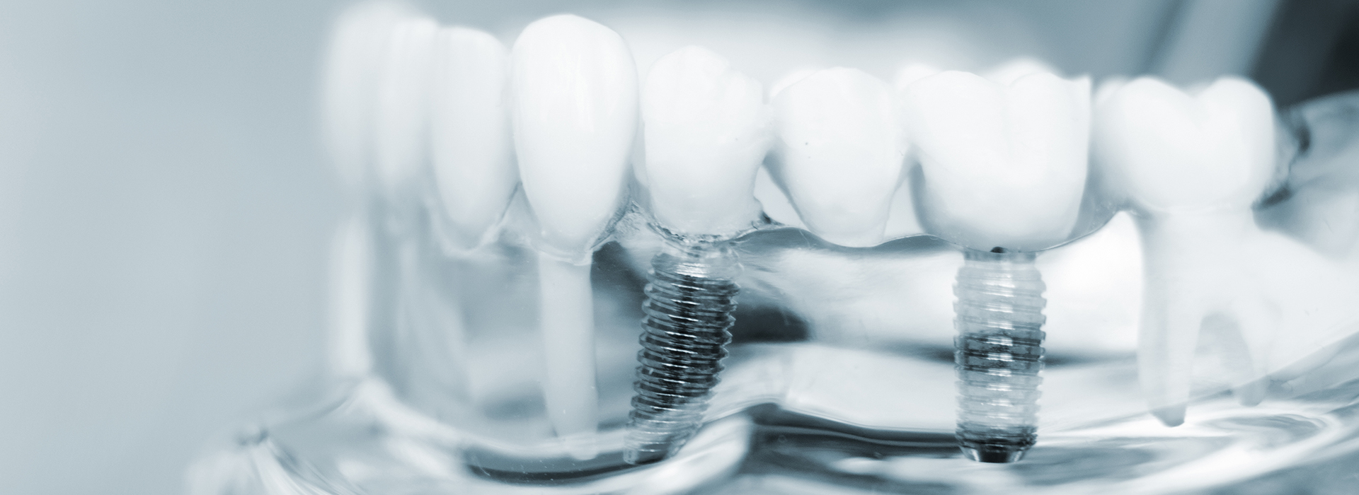 Dr. Anthony Iuvone, DMD | Implant Dentistry, Oral Cancer Screening and Dentures