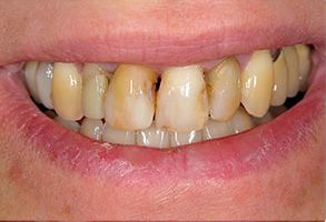 Dr. Anthony Iuvone, DMD | Full Mouth Reconstruction, Dental Bridges and Pediatric Dentistry